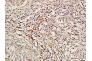 Formalin-fixed and paraffin embedded laryngeal cancer labeled with Rabbit Anti-KIF11 Polyclonal Antibody, Unconjugated  at 1:200 followed by conjugation to the secondary antibody and DAB staining (K11 (AA 351-450) Antikörper)