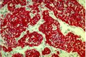 Renal cell carcinoma (MAb 2A4, cytokeratin 8, 18, 19)