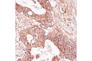 Immunohistochemistry of paraffin-embedded human colon carcinoma using MEK3 antibody (ABIN6130544, ABIN6143484, ABIN6143485 and ABIN6223650) at dilution of 1:100 (40x lens). (MAP2K3 Antikörper  (AA 1-170))