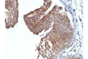 Immunohistochemical staining (Formalin-fixed paraffin-embedded sections) of human bladder carcinoma with KRT6 monoclonal antibody, clone KRT6/1702 . (KRT6A Antikörper)