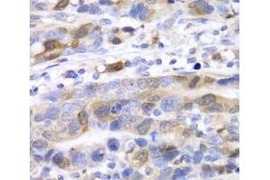 Immunohistochemistry of paraffin-embedded Human gastric cancer using UBE2C Polyclonal Antibody at dilution of 1:100 (40x lens). (UBE2C Antikörper)