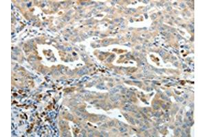 The image on the left is immunohistochemistry of paraffin-embedded Human ovarian cancer tissue using (PTEN Antibody) at dilution 1/20, on the right is treated with synthetic peptide. (PTEN Antikörper)