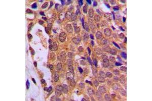 Immunohistochemical analysis of FOXO4 staining in human breast cancer formalin fixed paraffin embedded tissue section. (FOXO4 Antikörper  (Center))