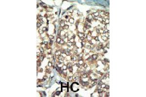 Formalin-fixed and paraffin-embedded human hepatocellular carcinoma tissue reacted with PI4K2B polyclonal antibody  , which was peroxidase-conjugated to the secondary antibody, followed by AEC staining. (PI4K2B Antikörper  (C-Term))