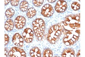 Formalin-fixed, paraffin-embedded human colon carcinoma stained with EpCAM Recombinant Rabbit Monoclonal Antibody (EGP40/1555R). (Rekombinanter EpCAM Antikörper  (N-Term))