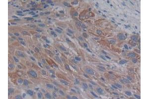 IHC-P analysis of Human Lung cancer Tissue, with DAB staining. (PCSK9 Antikörper  (AA 156-461))