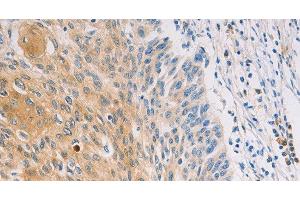 Immunohistochemistry of paraffin-embedded Human breast cancer tissue using MUC5B Polyclonal Antibody at dilution 1:30 (MUC5B Antikörper)