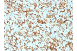 Formalin-fixed, paraffin-embedded human Histiocytoma stained with CD163 Mouse Monoclonal Antibody (M130/1210). (CD163 Antikörper  (AA 43-196))