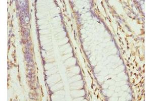 Immunohistochemistry of paraffin-embedded human colon cancer using ABIN7154797 at dilution of 1:100 (CLCN7 Antikörper  (AA 626-805))