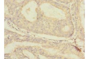 Immunohistochemistry of paraffin-embedded human endometrial cancer using ABIN7176671 at dilution of 1:100 (SLC3A1 Antikörper  (AA 328-507))