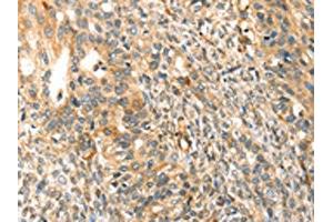 The image on the left is immunohistochemistry of paraffin-embedded Human breast cancer tissue using ABIN7192932(TRPV3 Antibody) at dilution 1/30, on the right is treated with synthetic peptide.