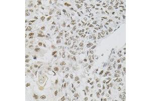 Immunohistochemistry of paraffin-embedded human lung cancer using FAF1 antibody (ABIN5975642) (40x lens). (FAF1 Antikörper)
