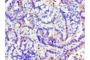 Immunohistochemistry of paraffin-embedded human lung cancer using ABIN7176599 at dilution of 1:100 (TRIM27 Antikörper  (AA 214-513))
