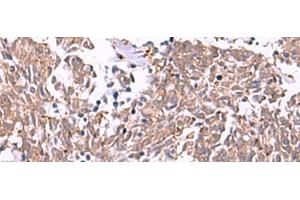 Immunohistochemistry of paraffin-embedded Human lung cancer tissue using IRX2 Polyclonal Antibody at dilution of 1:45(x200) (IRX2 Antikörper)