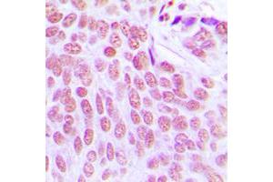 Immunohistochemical analysis of ITPKC staining in human breast cancer formalin fixed paraffin embedded tissue section. (ITPKC Antikörper  (Center))