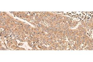 Immunohistochemistry of paraffin-embedded Human liver cancer tissue using LDAH Polyclonal Antibody at dilution of 1:55(x200) (LDAH/C2orf43 Antikörper)