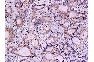 Formalin-fixed and paraffin embedded human colon carcinoma labeled with Anti-Survivin Polyclonal Antibody, Unconjugated (ABIN670911) at 1:200, followed by conjugation to the secondary antibody and DAB staining (Survivin Antikörper  (AA 85-142))