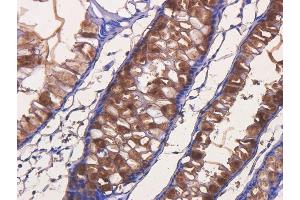 Immunohistochemical staining of human rectal carcinoma using anti-TAG72 antibody  Formalin fixed human rectal carcinoma slices were were stained with  at 5 µg/ml. (Rekombinanter TAG-72 (Satumomab Biosimilar) Antikörper)