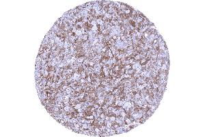 Hodgkins lymphoma containing a dense population of factor XIIIa positive cells (F13A1 Antikörper  (AA 46-181))