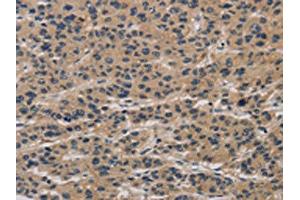 The image on the left is immunohistochemistry of paraffin-embedded Human liver cancer tissue using ABIN7190293(CLEC2A Antibody) at dilution 1/20, on the right is treated with synthetic peptide. (CLEC2A Antikörper)