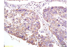 Formalin-fixed and paraffin embedded human lung carcinoma labeled with Anti-XAGE2 Polyclonal Antibody, Unconjugated (ABIN721750) at 1:200 followed by conjugation to the secondary antibody and DAB staining. (XAGE2 Antikörper  (AA 30-70))