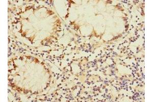 Immunohistochemistry of paraffin-embedded human colon cancer using ABIN7150754 at dilution of 1:100 (DUSP16 Antikörper  (AA 416-665))