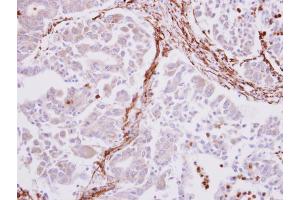 IHC-P Image alpha smooth muscle Actin antibody detects alpha smooth muscle Actin protein at cytoplasm on human liver carcinoma stroma by immunohistochemical analysis. (Smooth Muscle Actin Antikörper  (N-Term))
