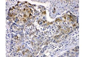 IHC testing of FFPE human esophageal squamous cancer with Cytokeratin 14 antibody at 1ug/ml. (KRT14 Antikörper  (AA 446-472))