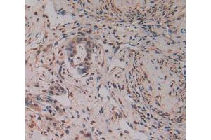 IHC-P analysis of pancreas cancer tissue, with DAB staining. (PAK2 Antikörper  (AA 177-419))