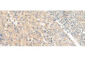 Immunohistochemistry of paraffin-embedded Human cervical cancer tissue using CHP1 Polyclonal Antibody at dilution of 1:25(x200)
