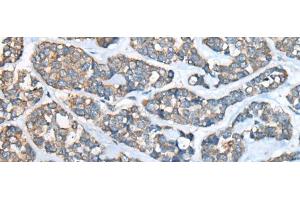 Immunohistochemistry of paraffin-embedded Human esophagus cancer tissue using GULP1 Polyclonal Antibody at dilution of 1:65(x200)