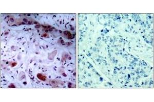 Immunohistochemistry analysis of paraffin-embedded human breast carcinoma, using JAK1 (Phospho-Tyr1022) Antibody. (JAK1 Antikörper  (pTyr1022))