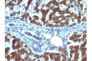 Formalin-fixed, paraffin-embedded human Hepatocellular Carcinoma stained with RBP1 (RBP/872) (RBP1 Antikörper)
