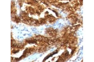 IHC testing of human prostate carcinoma with TAG-72 antibody (CA72/733). (TAG-72 Antikörper)