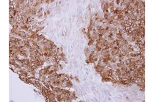 IHC-P Image Profilin 2 antibody detects PFN2 protein at cytoplasm on human colon carcinoma by immunohistochemical analysis. (PFN2 Antikörper)