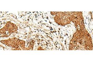 Immunohistochemistry of paraffin-embedded Human esophagus cancer tissue using SMOC1 Polyclonal Antibody at dilution of 1:50(x200) (SMOC1 Antikörper)