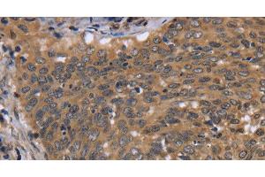 Immunohistochemistry of paraffin-embedded Human cervical cancer using FGFR1OP Polyclonal Antibody at dilution of 1:40 (FGFR1OP Antikörper)