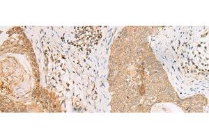 Immunohistochemistry of paraffin-embedded Human esophagus cancer tissue using PAX5 Polyclonal Antibody at dilution of 1:30(x200) (PAX5 Antikörper)