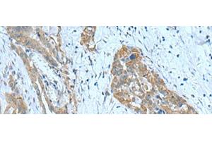 Immunohistochemistry of paraffin-embedded Human thyroid cancer tissue using SRPK2 Polyclonal Antibody at dilution of 1:90(x200) (SRPK2 Antikörper)