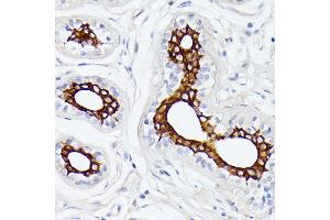 Immunohistochemistry of paraffin-embedded human breast cancer using MT-ND5 antibody (ABIN7268603) at dilution of 1:100 (40x lens). (MT-ND5 Antikörper  (C-Term))