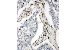 Anti-DR5 antibody, IHC(P) IHC(P): Human Lung Cancer Tissue (TNFRSF10B Antikörper  (C-Term))