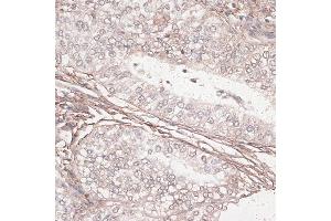 Immunohistochemistry of paraffin-embedded human uterine cancer using L antibody (ABIN7268186) at dilution of 1:100 (40x lens). (Laminin gamma 1 Antikörper  (AA 1300-1609))