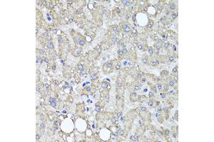 Immunohistochemistry of paraffin-embedded human liver injury using MUC16 antibody (ABIN6003713) at dilution of 1/100 (40x lens). (MUC16 Antikörper)