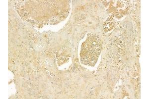 ABIN6262808 and ABIN6277591 at 1/100 staining human prostate carcinoma by IHC-P.