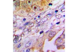 Immunohistochemical analysis of MP68 staining in human lung cancer formalin fixed paraffin embedded tissue section. (C14orf2 Antikörper  (Center))