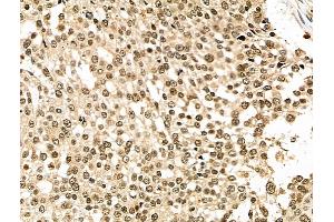 ABIN6262581 and ABIN6276765 at 1/100 staining Human ovarian cancer by IHC-P. (IDO1 Antikörper  (Internal Region))