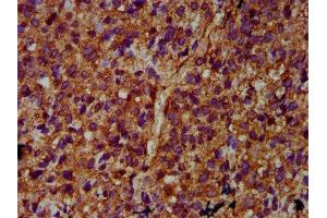 IHC image of ABIN7169209 diluted at 1:400 and staining in paraffin-embedded human glioma performed on a Leica BondTM system. (ULK2 Antikörper  (AA 211-276))