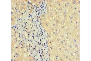 Immunohistochemistry of paraffin-embedded human liver cancer using ABIN7162135 at dilution of 1:100