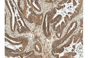 Immunohistochemistry analysis using Rabbit Anti-MDM2 Polyclonal Antibody (ABIN5667994). (MDM2 Antikörper  (AA 100-200) (Atto 390))