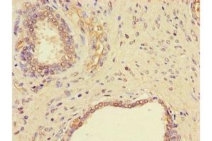 Immunohistochemistry of paraffin-embedded human prostate cancer using ABIN7145523 at dilution of 1:100 (Nerve Growth Factor Antikörper  (AA 122-218))